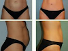 Masajes Reduct Mesoterapia Liposuccion Virtual