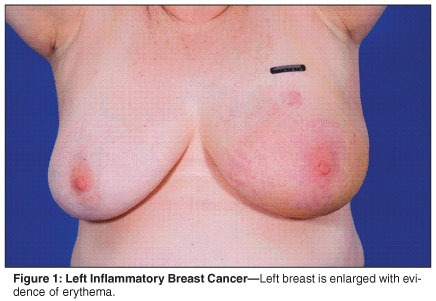 [Breast-Cancer3.jpg]