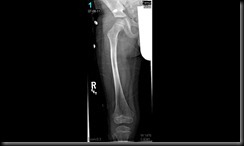 Broken femur healing 7-8-2011 (1)