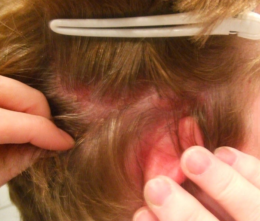 [home%2520remedies%2520for%2520dandruff%2520and%2520dry%2520scalp_5%255B4%255D.jpg]