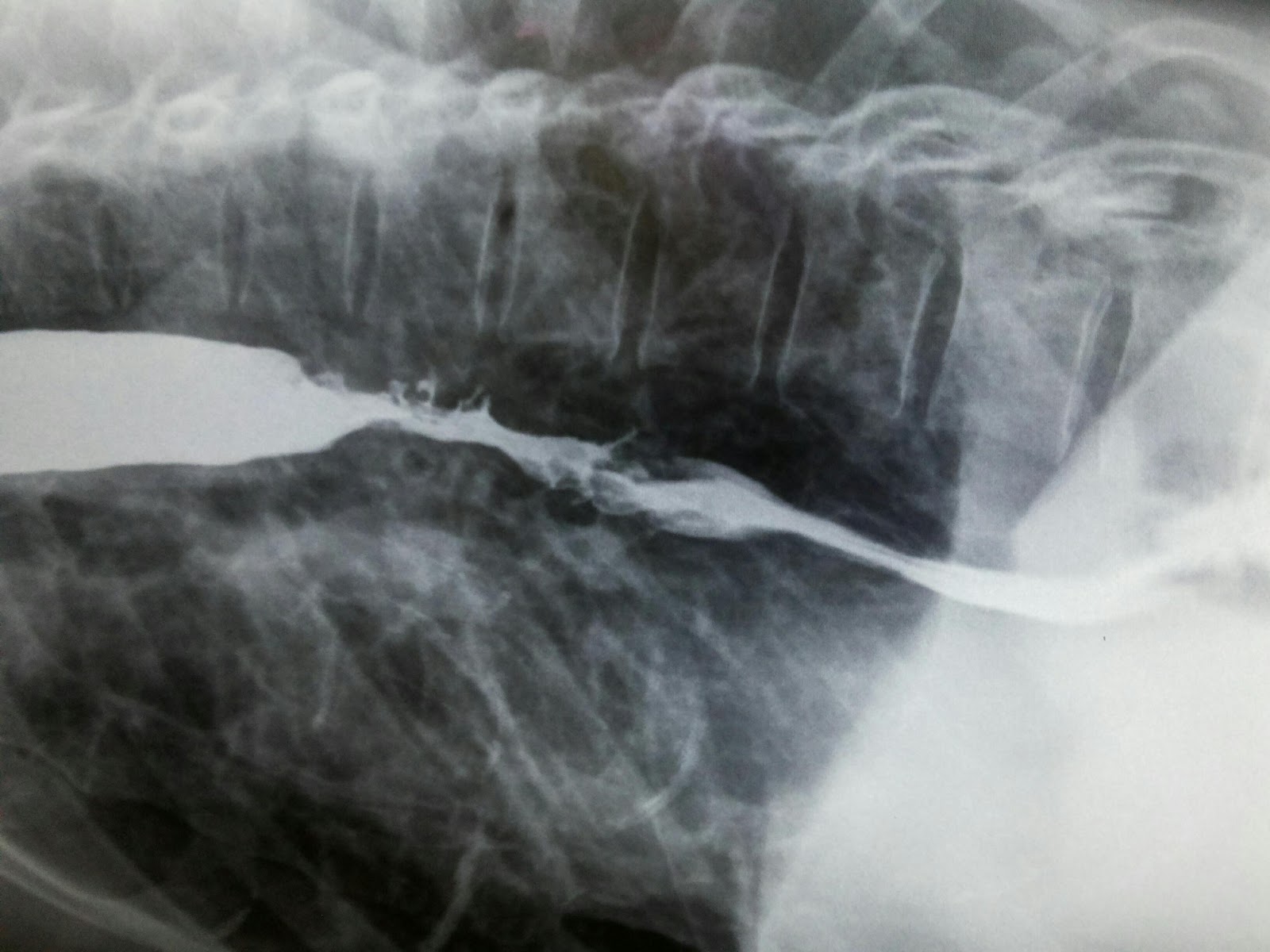 RADIOLOGY IMAGE SPOTTERS Carcinoma esophagus barium swallow