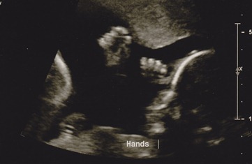 2012-01-11 ultrasound 3