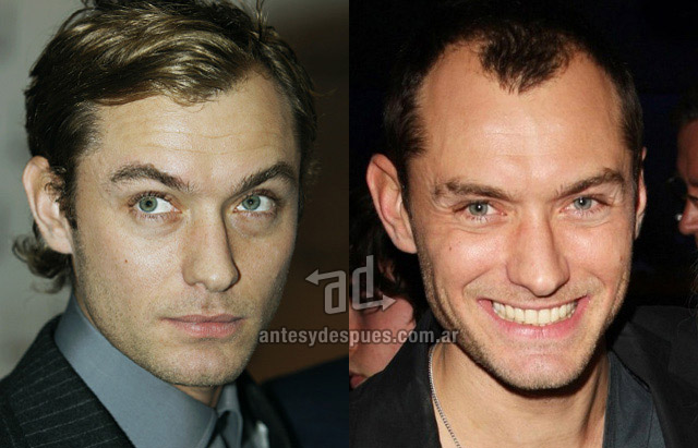 Hair Loss Before & After of  Jude Law