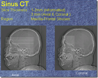 CT SINUS