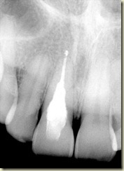 Internal Resorption SB final radiograph012