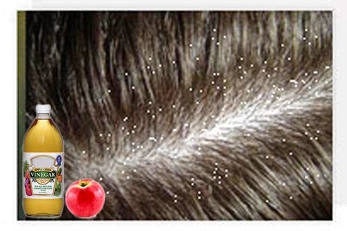 home remedies for dandruff and dry scalp_1
