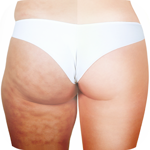 How to Get Rid of Cellulite 1.0