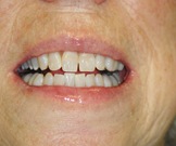 Patient A after whitening