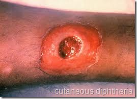 cutaneous diphtheria