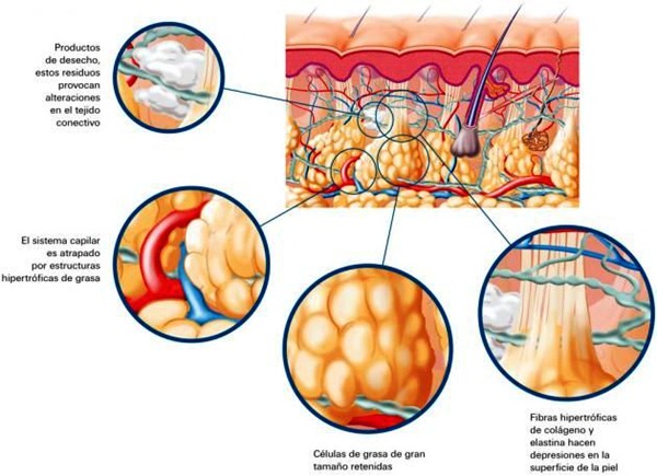 ¿Cuáles son las Causas de la Celulitis? | Eliminar La Celulitis ...