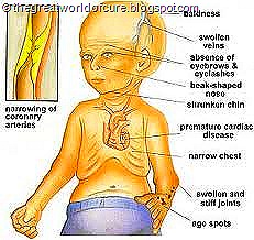 Progeria : The old aged Children ~ THE GREAT WORLD OF CURE