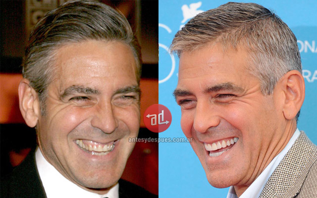 New teeth of George Clooney