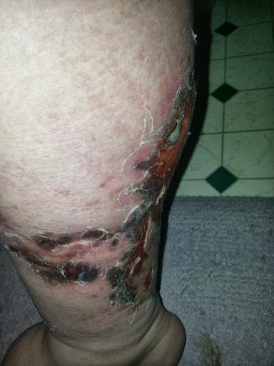 ## Cellulite Massage Roller Machine 70415 - stiperec