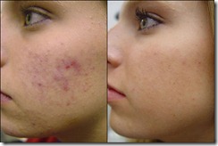 acne-no-more-treatment