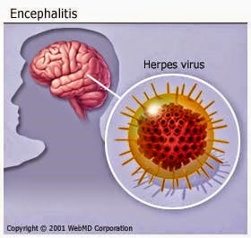 [viral-encephalitis-15997_03.jpg]