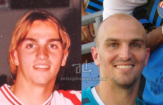 La caida del pelo de Esteban Cambiasso