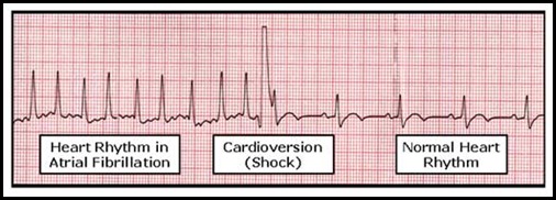 Cardioversion