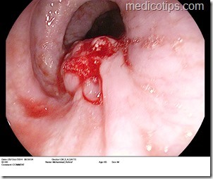 endoscopic view of esophgeal growth, by dr siddique akbar satti