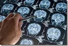 Studio USA scopre causa Alzheimer