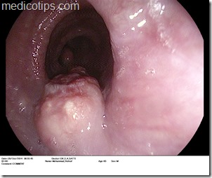 endoscopic view of esophageal growth by dr siddique akbar satti of capital hospital islambad