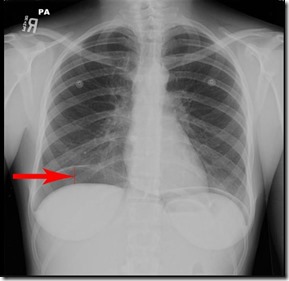 X-ray chest air under diaphragm intestinal perforation