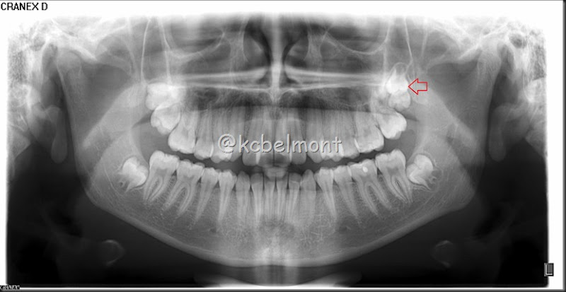 quarto molar superior equerdo (2)