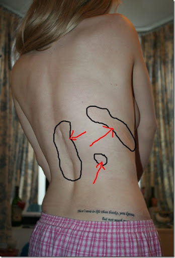 Scoliosis Awareness  How impressive is this tattoo  Facebook