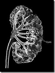 medullary sponge kidney