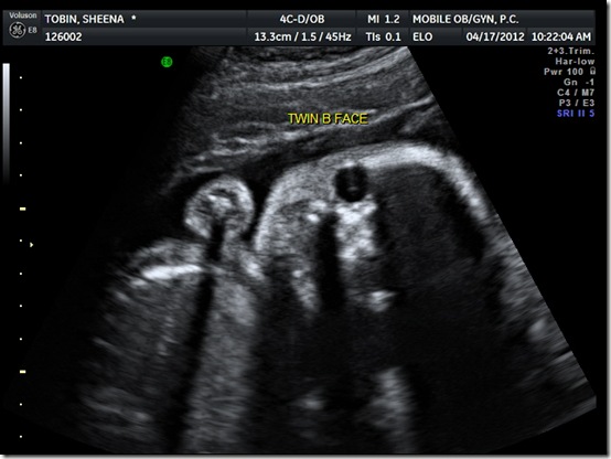 25 week ultrasound 007