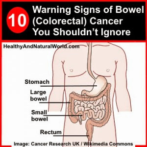 10 Warning Signs of Bowel (Colorectal) Cancer You Shouldn’t Ignore