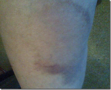 bruise day 9