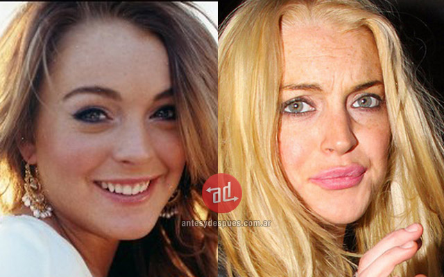 Foto del aumento de labios de Lindsay Lohan