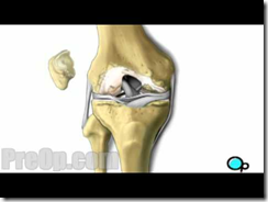 Knee Replacement Surgery, Patient Education #health #salud