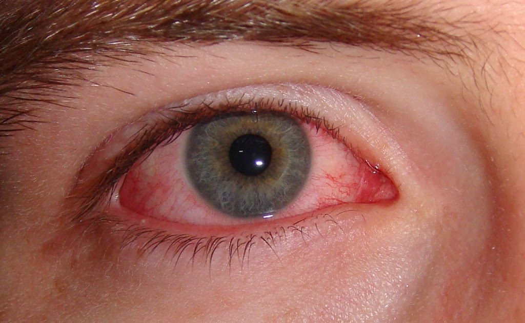 [home%2520remedies%2520for%2520eye%2520infections_2%255B4%255D.jpg]