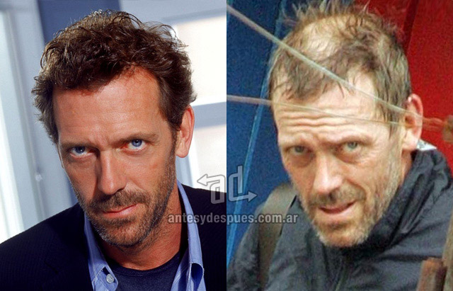 La caida del pelo de Hugh Laurie