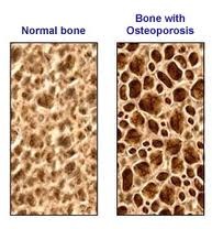 [osteoporosis%255B3%255D.jpg]