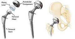 artificial hip