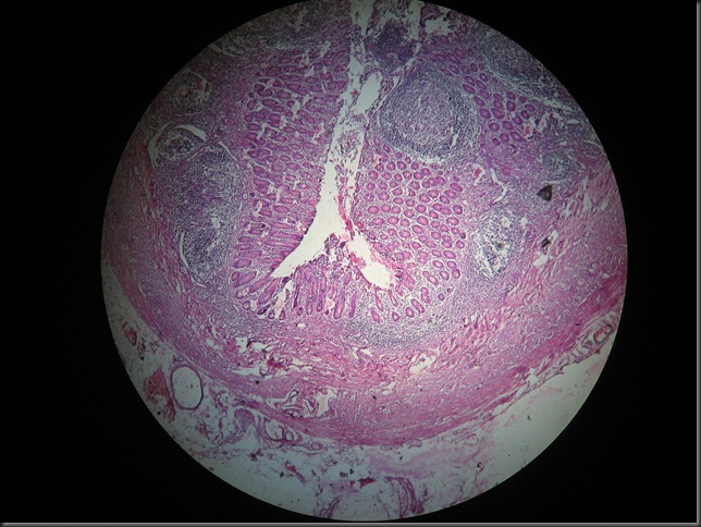 Acute Appendicitis high resolution histology slide tsnaps