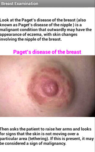 【免費醫療App】Breast Examination-APP點子