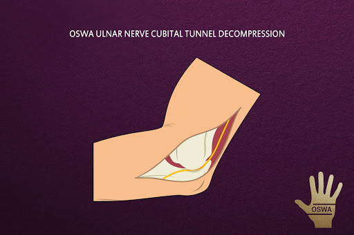 OSWA Ulnar Nerve App