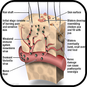 Shingles Symptoms Treatment.apk 1.0