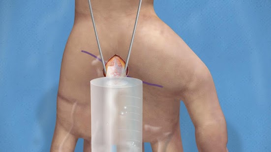 How to download Carpal Tunnel Surgery 1.0 mod apk for laptop