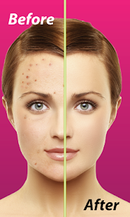 Download Pimple Remover APK for Android