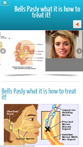 【免費醫療App】Bells Palsy-APP點子