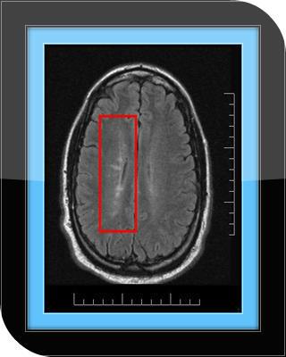 Brain Lesions - Guide