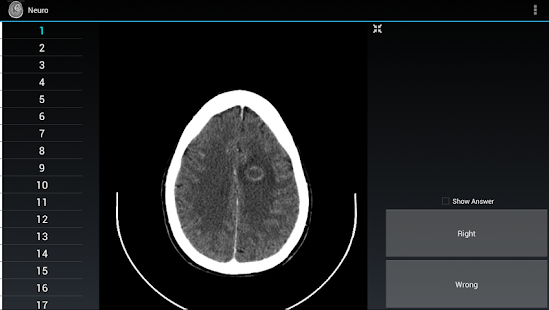 Radiology Flashcards: Neuro