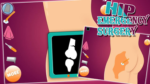 Virtual hip emergency surgery