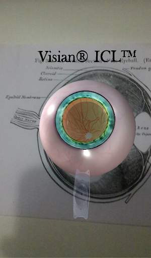 Visian ICL