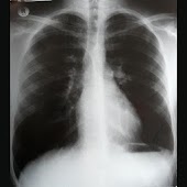 TB Proof: TB Risk Report Form