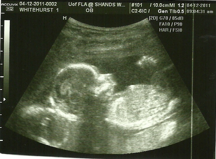 [Baby 1 Profile @ 17 weeks[3].jpg]